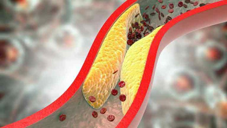 Cholesterol: नसों में कोलेस्ट्रॉल जमने का ये होता है सबसे बड़ा संकेत, इग्नोर करना पड़ सकता है भारी