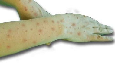 Optical Biosensor: इस खास टेक्नोलॉजी से मिनटों में पता चल जाएगा मंकीपॉक्स है या नहीं, जानें कैसे