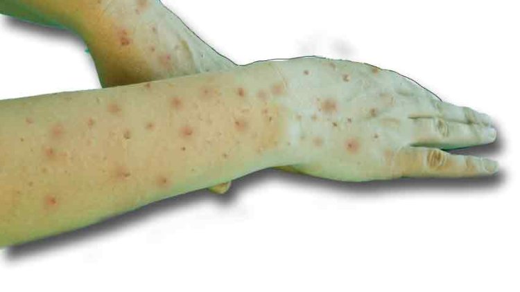 Optical Biosensor: इस खास टेक्नोलॉजी से मिनटों में पता चल जाएगा मंकीपॉक्स है या नहीं, जानें कैसे